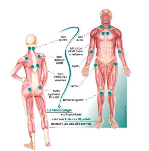 fibromyalgie-points